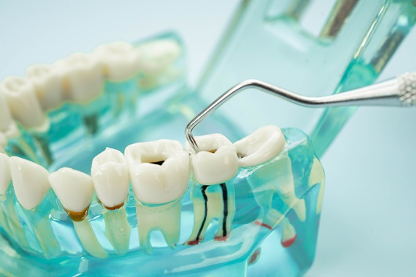 The Root Canal Procedure Explained: Step By Step